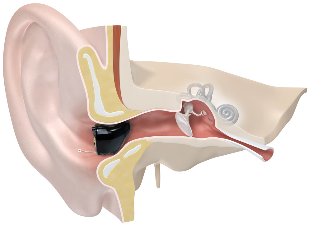 Ein CIC-Hörgerät, das korrekt im Gehörgang sitzt